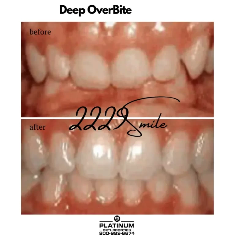 Before & after: Deep Overbite