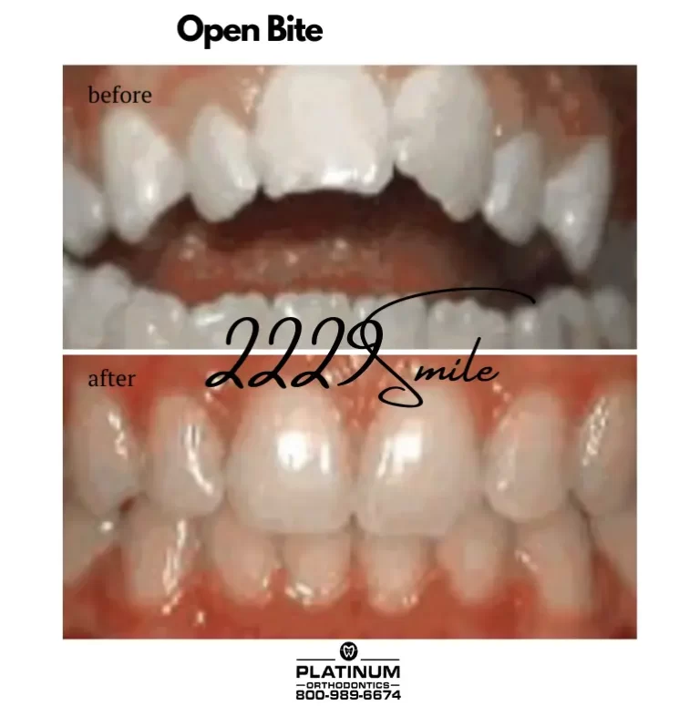 Before & after: Open Bite